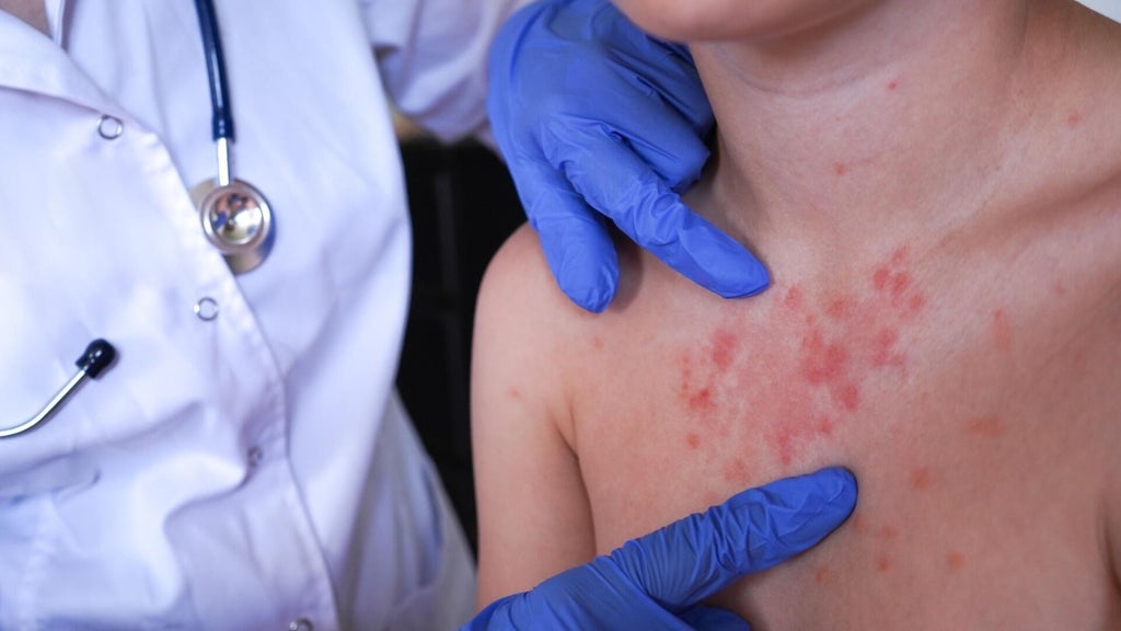 Minnesota's 80 measles cases this year are the most since 1990, health officials say — Orono Health news