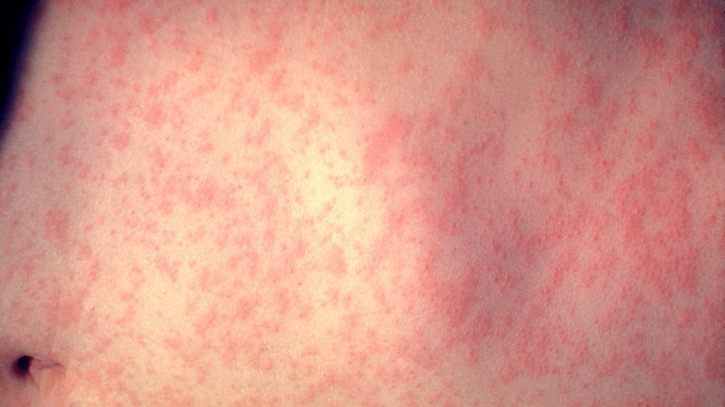 25 cases of measles identified in central, southeastern Minnesota, MDH says — WCCO / CBS Minnesota, Orono Health news